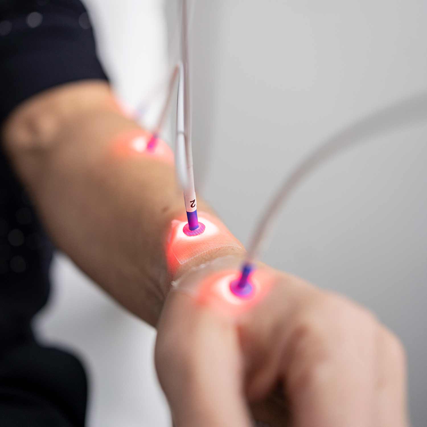 schnellende Finger oder auch Triggerfinger Behandlung