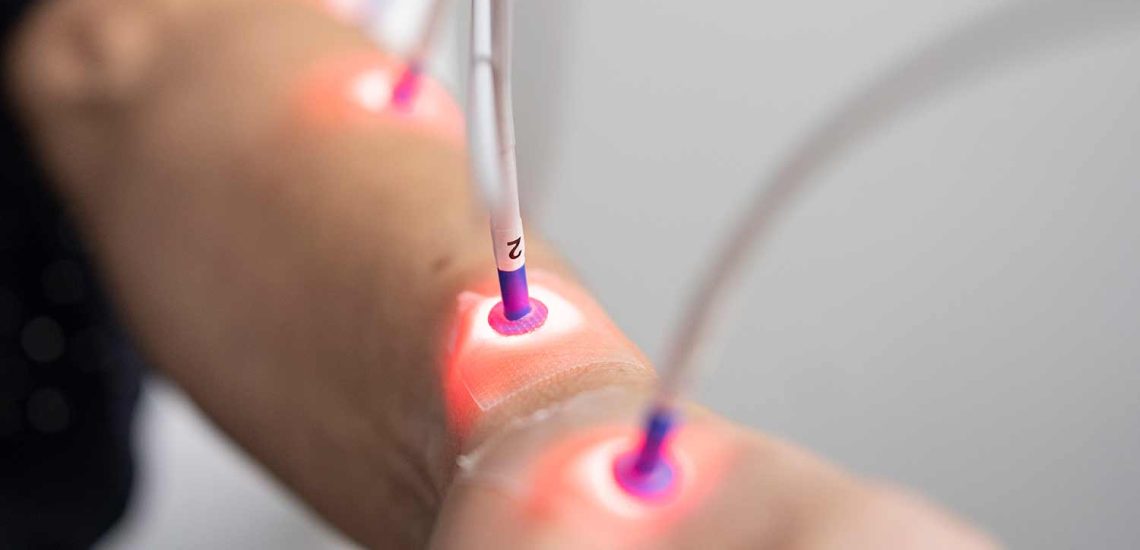 schnellende Finger oder auch Triggerfinger Behandlung